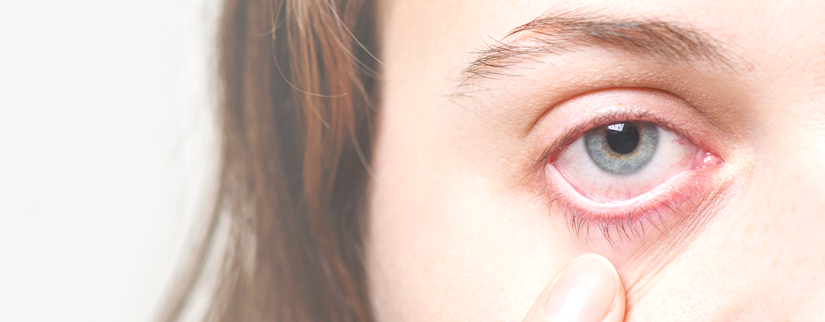 Alergia nos olhos: conheça os principais tipos - Centro de Catarata  Madureira