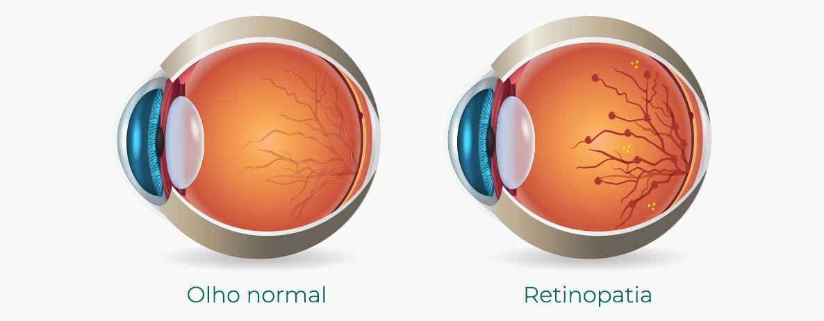 Retinopatia diabética: conheça os tipos e tratamentos