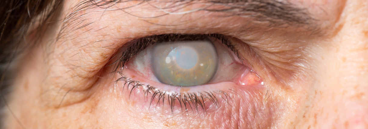 Opacificação do cristalino